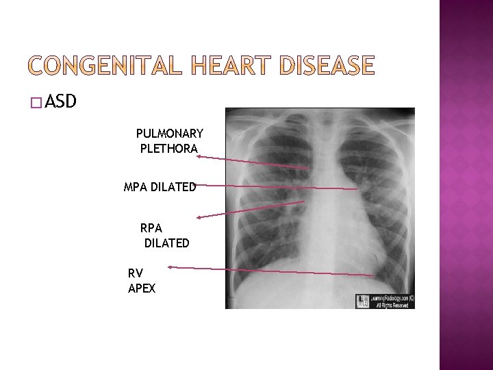 � ASD PULMONARY PLETHORA MPA DILATED RV APEX 