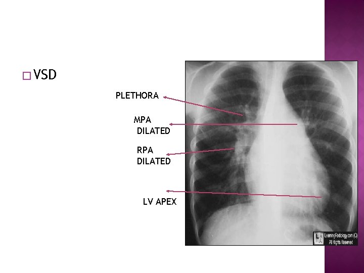 � VSD PLETHORA MPA DILATED RPA DILATED LV APEX 