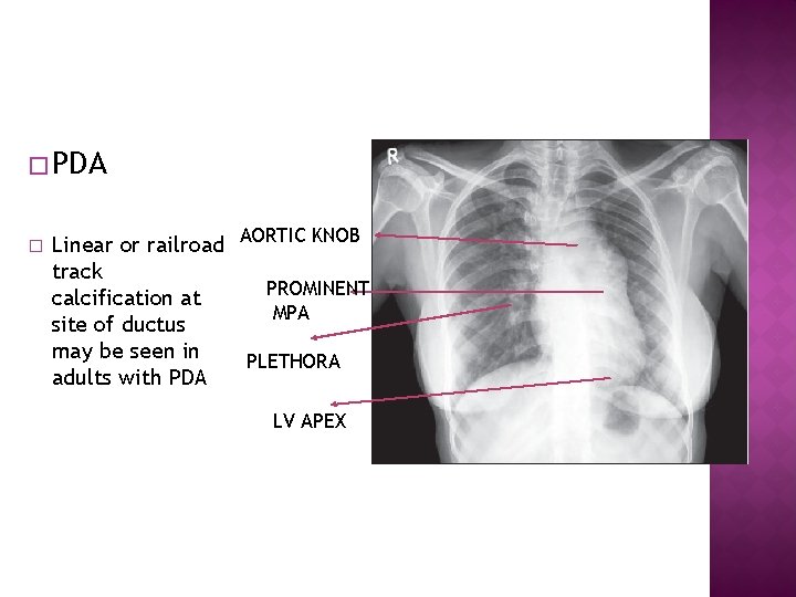 � PDA � Linear or railroad AORTIC KNOB track PROMINENT calcification at MPA site
