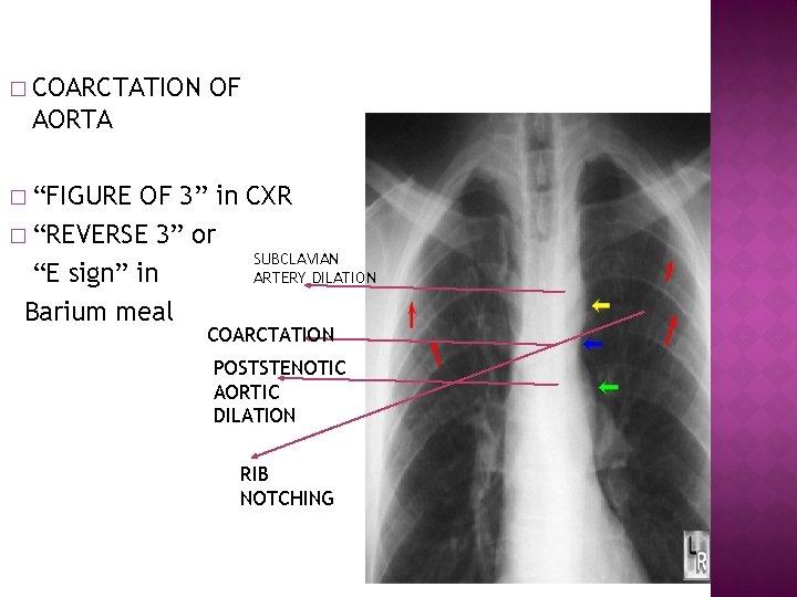 � COARCTATION OF AORTA � “FIGURE OF 3” in CXR � “REVERSE 3” or