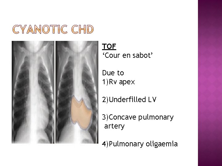 TOF ‘Cour en sabot’ Due to 1)Rv apex 2)Underfilled LV 3)Concave pulmonary artery 4)Pulmonary