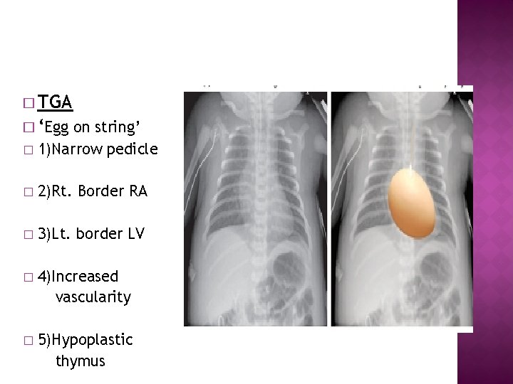 � TGA � ‘Egg on string’ � 1)Narrow pedicle � 2)Rt. Border RA �