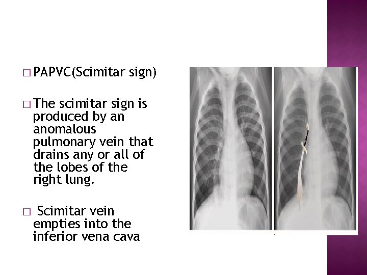 � PAPVC(Scimitar sign) � The scimitar sign is produced by an anomalous pulmonary vein