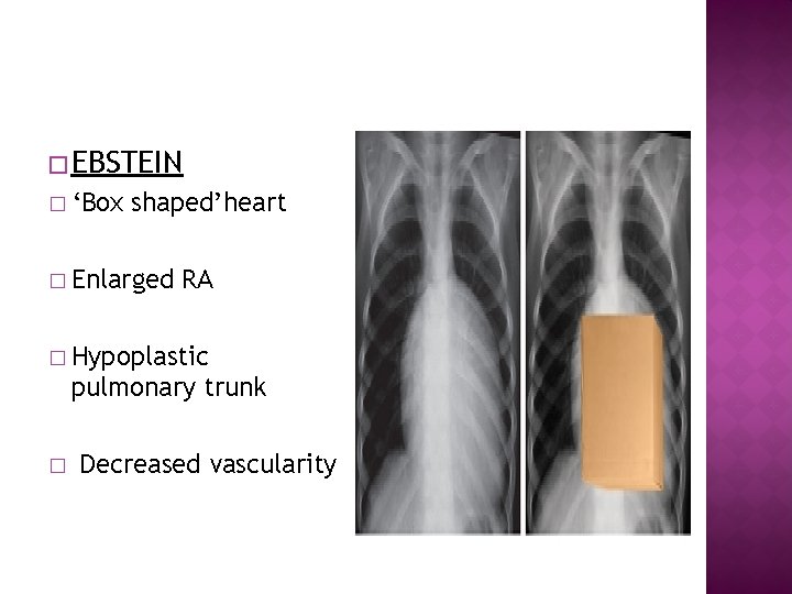 � EBSTEIN � ‘Box shaped’heart � Enlarged RA � Hypoplastic pulmonary trunk � Decreased