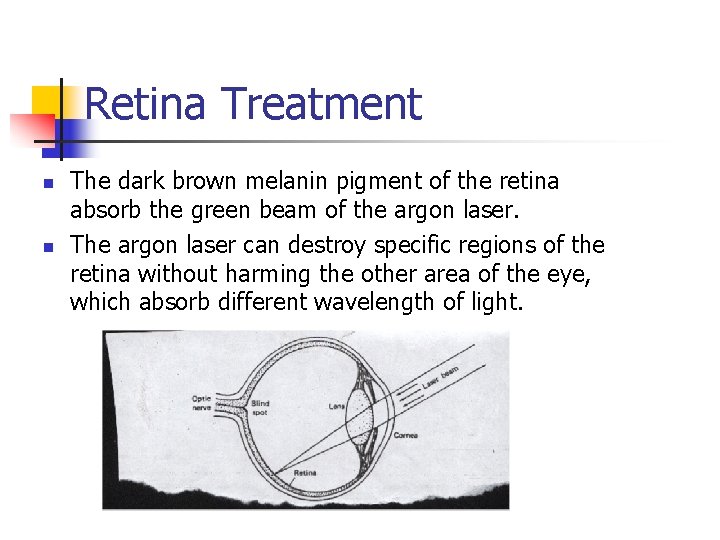 Retina Treatment n n The dark brown melanin pigment of the retina absorb the