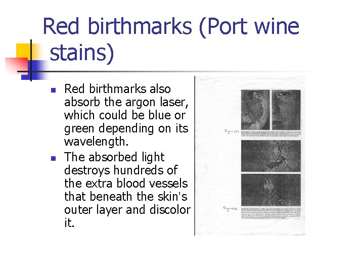Red birthmarks (Port wine stains) n n Red birthmarks also absorb the argon laser,