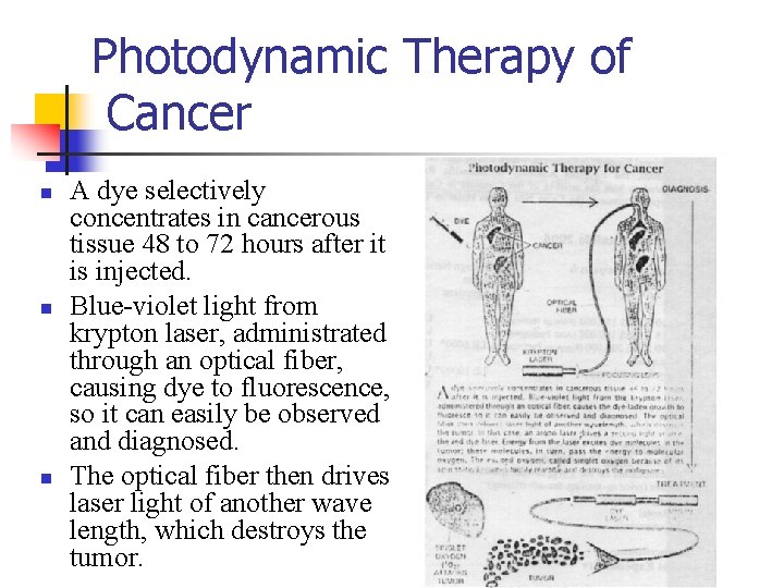 Photodynamic Therapy of Cancer n n n A dye selectively concentrates in cancerous tissue