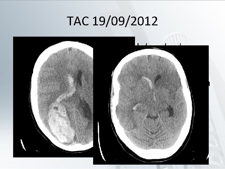 TAC 19/09/2012 • Hematoma temporooccipital derecho de 7 x 2. 4 x 4. 4