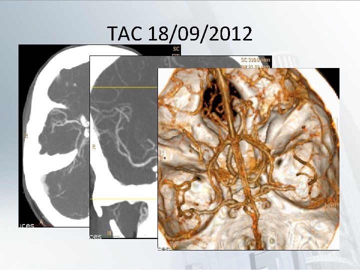 TAC 18/09/2012 • Trombo en segmento distal de M 1 izquierda. • Hipodensidad en
