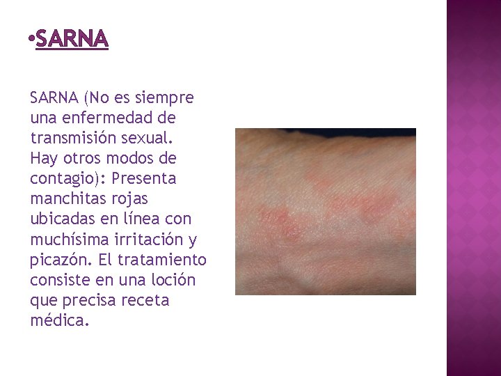  • SARNA (No es siempre una enfermedad de transmisión sexual. Hay otros modos