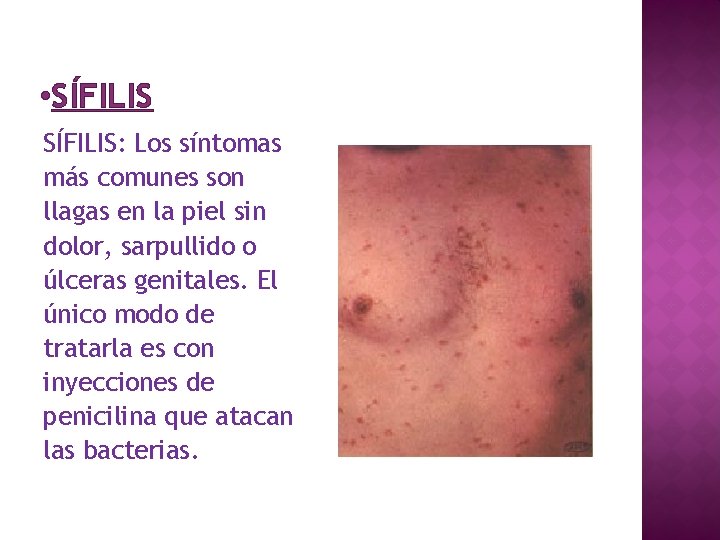  • SÍFILIS: Los síntomas más comunes son llagas en la piel sin dolor,