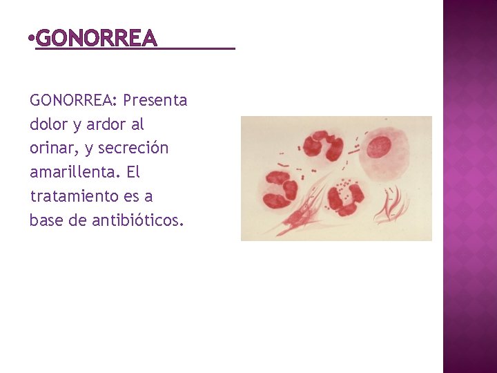  • GONORREA: Presenta dolor y ardor al orinar, y secreción amarillenta. El tratamiento