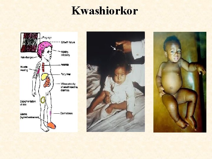 Kwashiorkor 