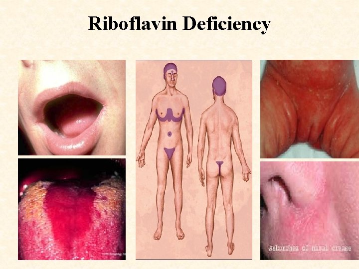 Riboflavin Deficiency 