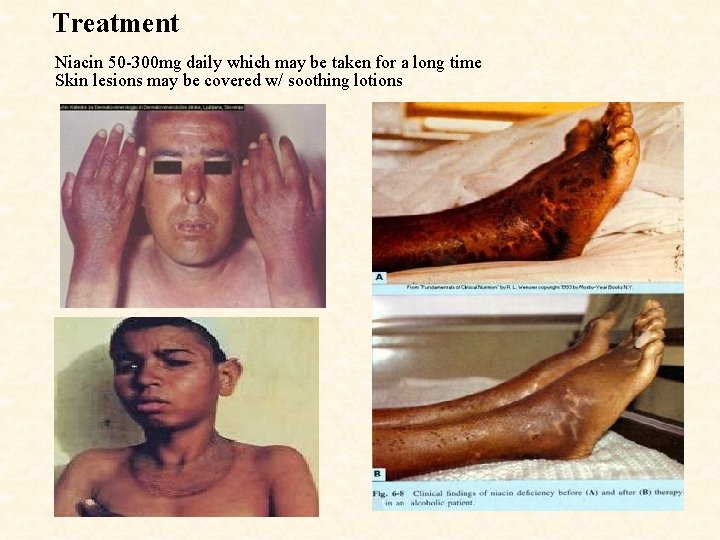  Treatment Niacin 50 -300 mg daily which may be taken for a long