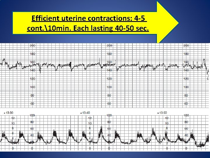 Efficient uterine contractions: 4 -5 cont. 10 min. Each lasting 40 -50 sec. 