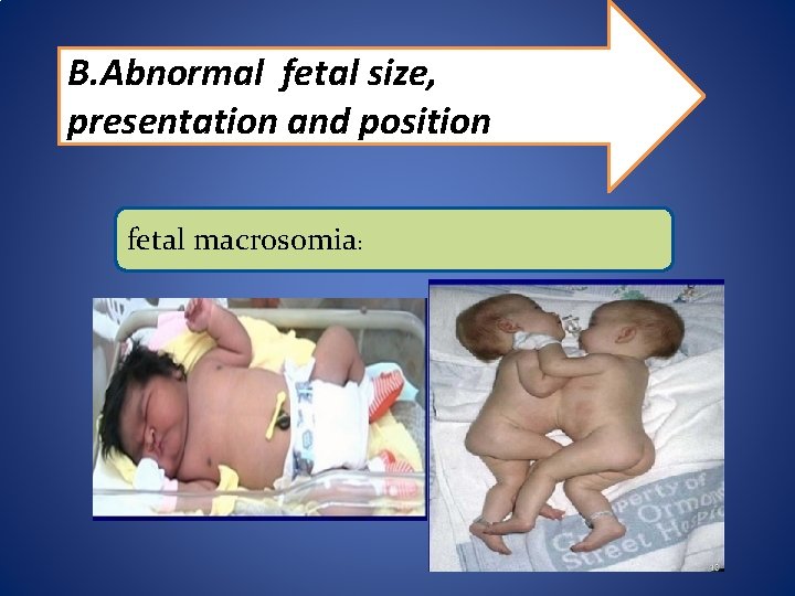 B. Abnormal fetal size, presentation and position fetal macrosomia: 