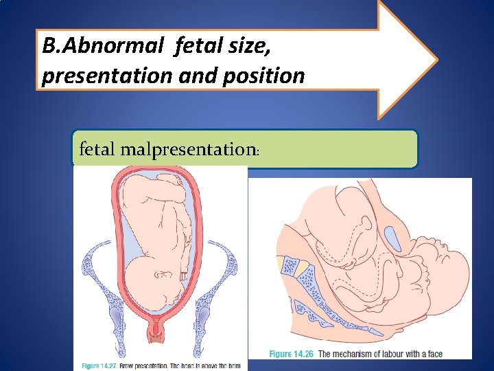 B. Abnormal fetal size, presentation and position fetal malpresentation: 