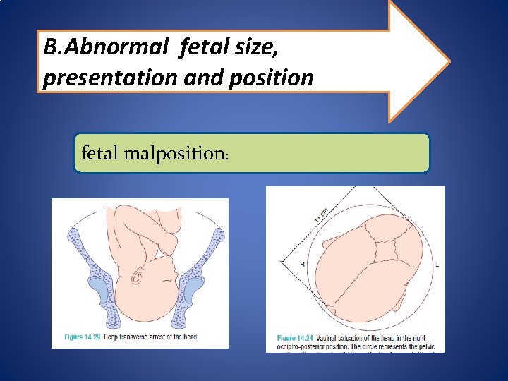 B. Abnormal fetal size, presentation and position fetal malposition: 