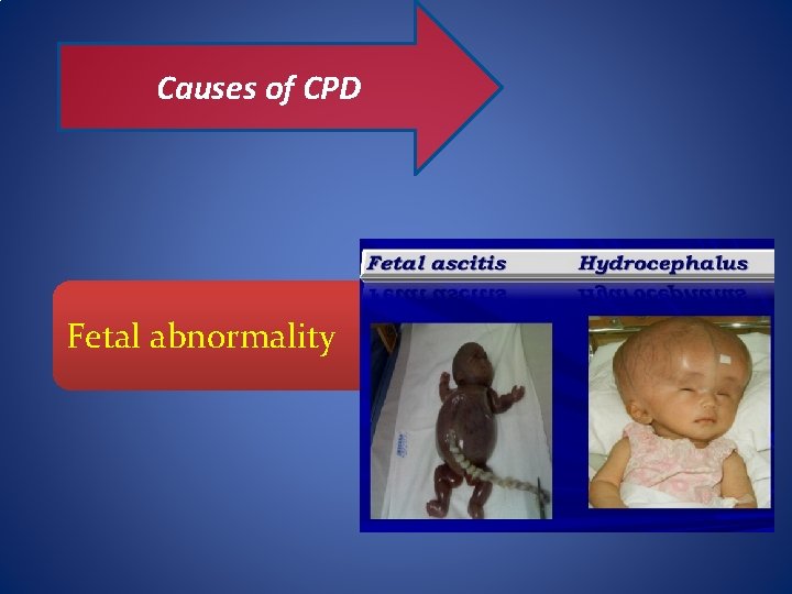 Causes of CPD Fetal abnormality 