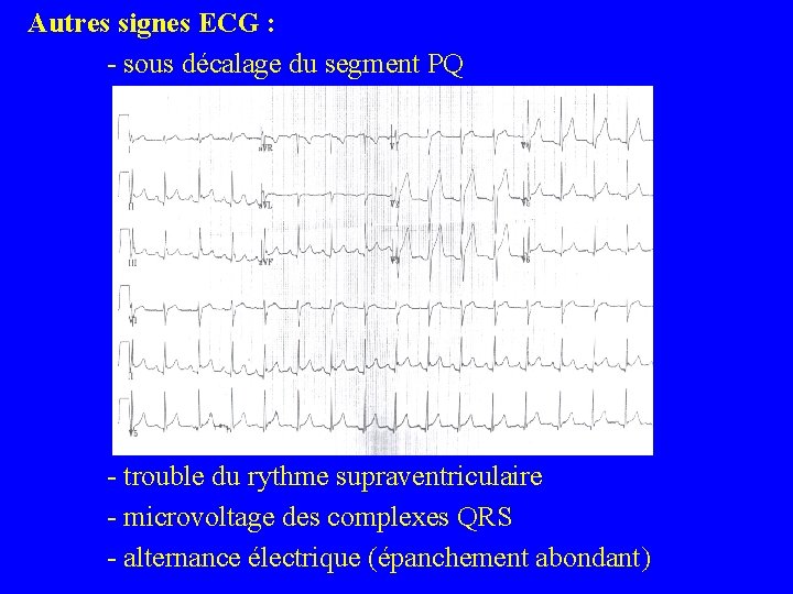 Autres signes ECG : - sous décalage du segment PQ - trouble du rythme