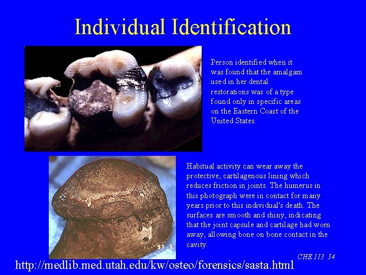 Individual Identification Person identified when it was found that the amalgam used in her