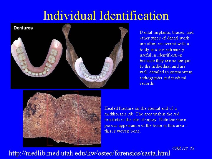 Individual Identification Dental implants, braces, and other types of dental work are often recovered