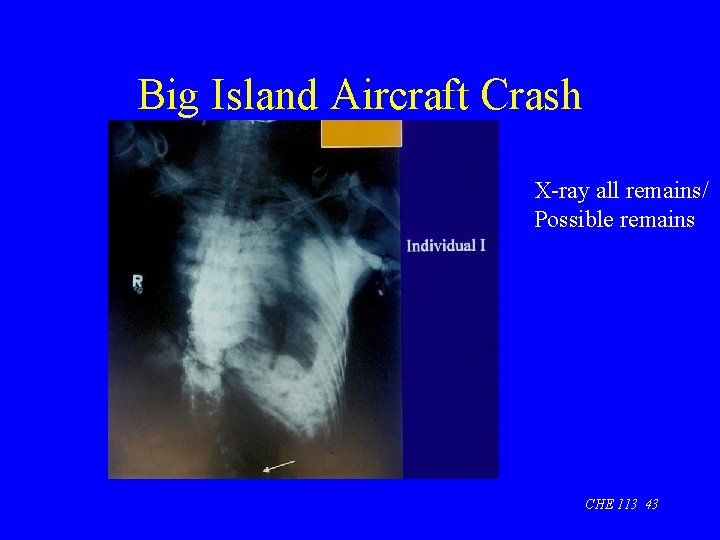 Big Island Aircraft Crash X-ray all remains/ Possible remains CHE 113 43 