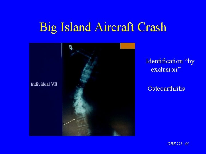 Big Island Aircraft Crash Identification “by exclusion” Osteoarthritis CHE 113 46 