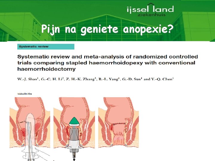 Pijn na geniete anopexie? 14 