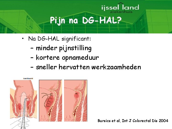 Pijn na DG-HAL? • Na DG-HAL significant: – minder pijnstilling – kortere opnameduur –