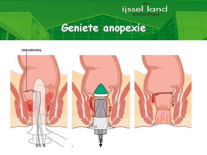 Geniete anopexie 5 