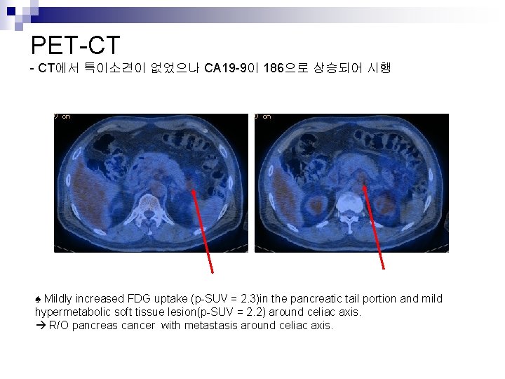 PET-CT - CT에서 특이소견이 없었으나 CA 19 -9이 186으로 상승되어 시행 ♠ Mildly increased