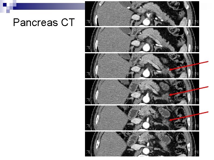 Pancreas CT 