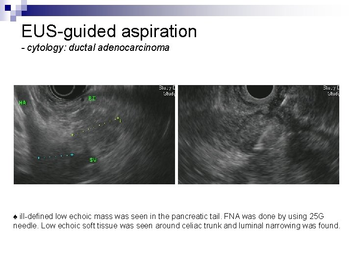 EUS-guided aspiration - cytology: ductal adenocarcinoma ♠ ill-defined low echoic mass was seen in