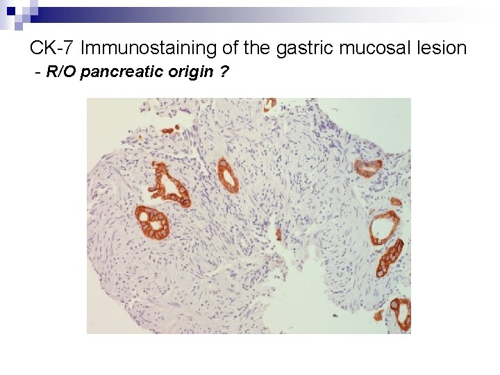 CK-7 Immunostaining of the gastric mucosal lesion - R/O pancreatic origin ? 