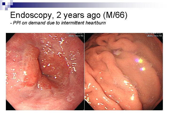 Endoscopy, 2 years ago (M/66) - PPI on demand due to intermittent heartburn 