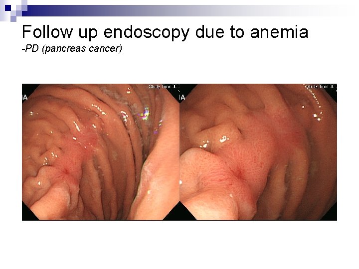 Follow up endoscopy due to anemia -PD (pancreas cancer) 