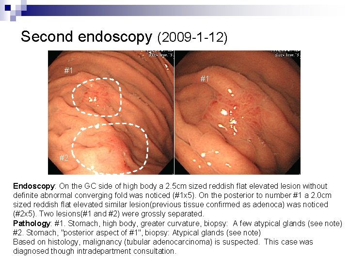 Second endoscopy (2009 -1 -12) #1 #1 #2 Endoscopy: On the GC side of