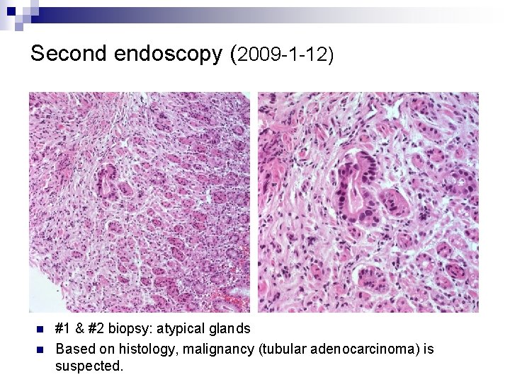 Second endoscopy (2009 -1 -12) n n #1 & #2 biopsy: atypical glands Based