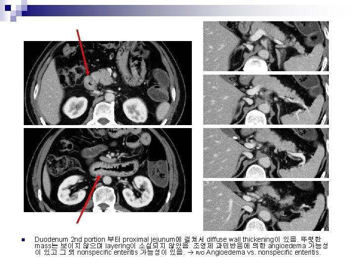 n Duodenum 2 nd portion 부터 proximal jejunum에 걸쳐서 diffuse wall thickening이 있음. 뚜렷한