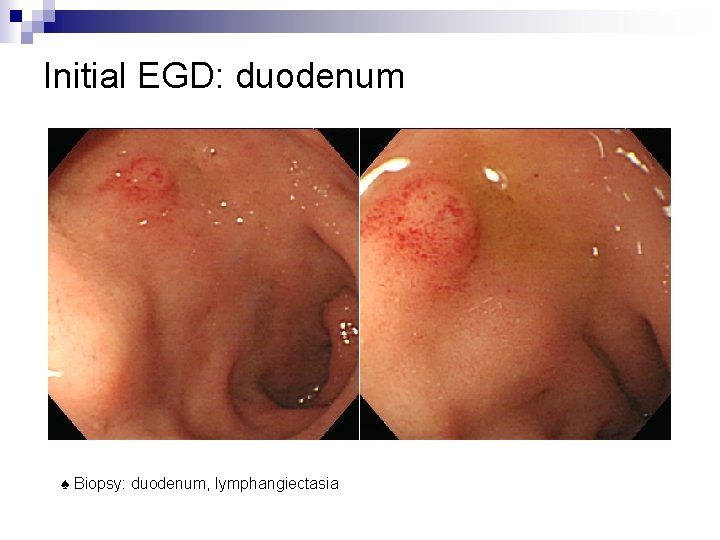 Initial EGD: duodenum ♠ Biopsy: duodenum, lymphangiectasia 