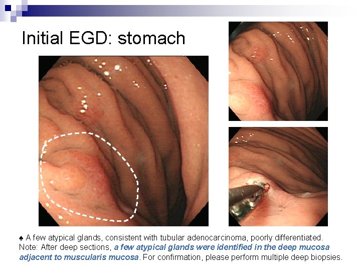 Initial EGD: stomach ♠ A few atypical glands, consistent with tubular adenocarcinoma, poorly differentiated.