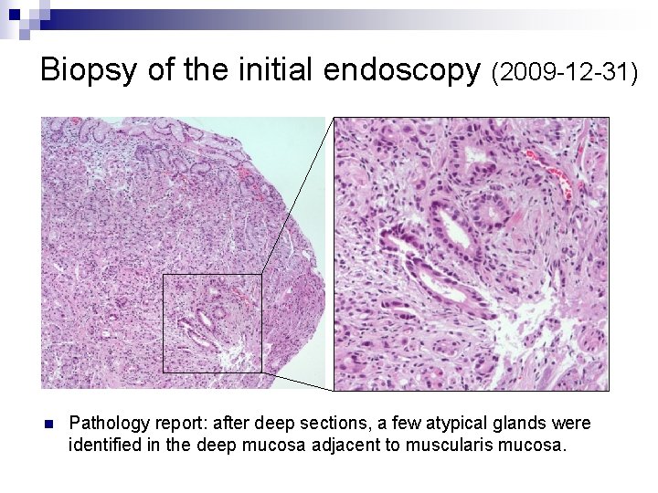 Biopsy of the initial endoscopy (2009 -12 -31) n Pathology report: after deep sections,