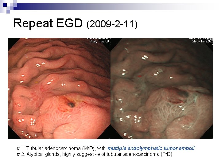 Repeat EGD (2009 -2 -11) # 1. Tubular adenocarcinoma (M/D), with multiple endolymphatic tumor