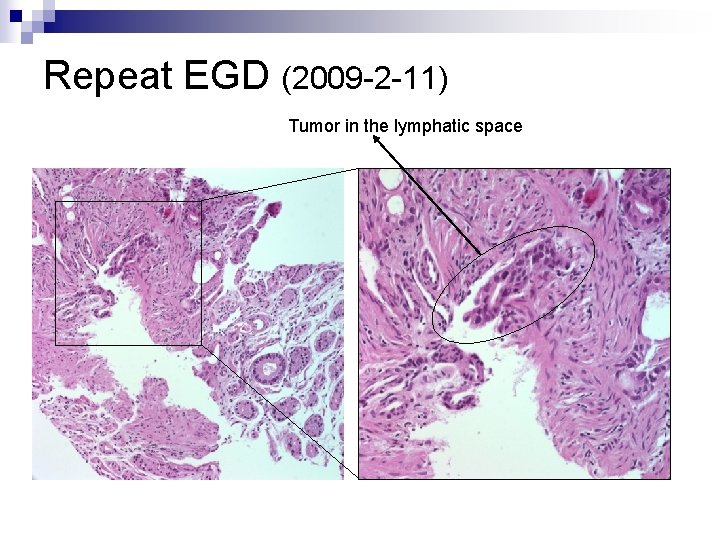 Repeat EGD (2009 -2 -11) Tumor in the lymphatic space 