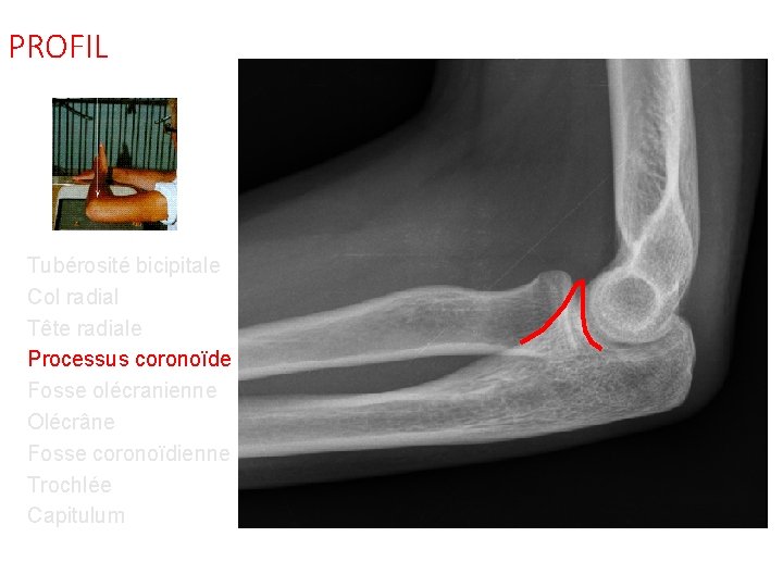 PROFIL Tubérosité bicipitale Col radial Tête radiale Processus coronoïde Fosse olécranienne Olécrâne Fosse coronoïdienne