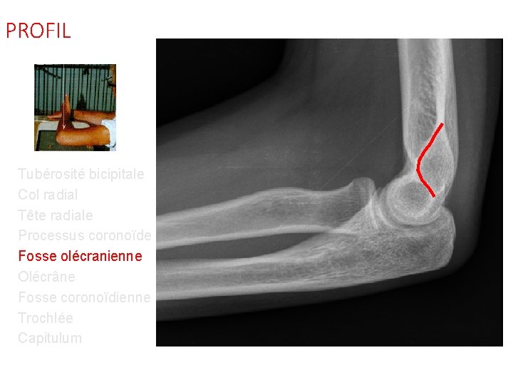 PROFIL Tubérosité bicipitale Col radial Tête radiale Processus coronoïde Fosse olécranienne Olécrâne Fosse coronoïdienne