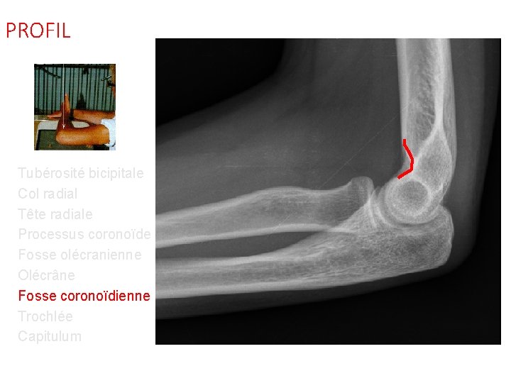 PROFIL Tubérosité bicipitale Col radial Tête radiale Processus coronoïde Fosse olécranienne Olécrâne Fosse coronoïdienne