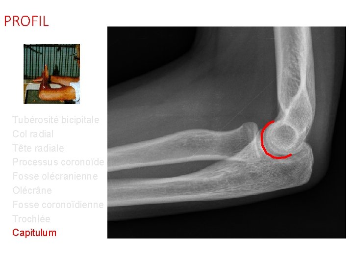 PROFIL Tubérosité bicipitale Col radial Tête radiale Processus coronoïde Fosse olécranienne Olécrâne Fosse coronoïdienne